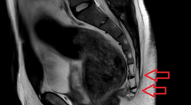 MRI sacrum.jpg